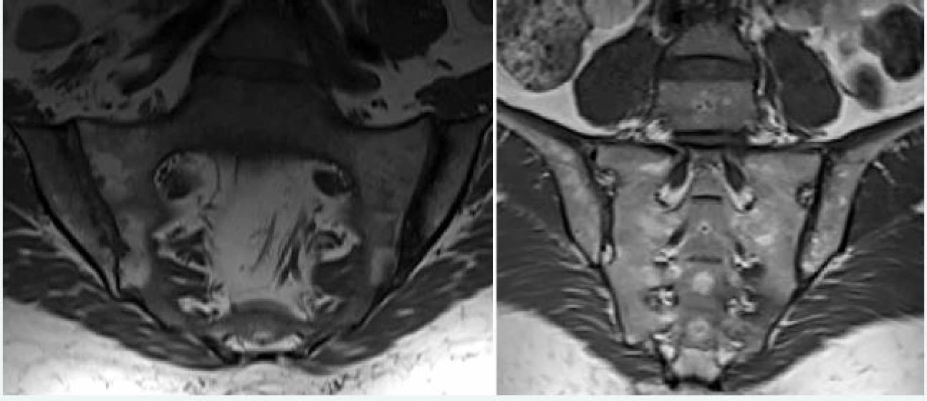 Tuková konverzia (metaplázia) kostnej drene u pacienta s axiálnou SpA. Na ľavej časti obrázka prítomný hyperintezívny signál v T1W obraze lokalizovaný subchondrálne, prítomnosť početných erózií SI skĺbenia zvyšuje pravdepodobnosť zápalovej etiológie. Na pravej časti obrázka prítomná heterogénna tuková infiltrácia v strednej časti sakrálnej kosti (interforaminálna oblasť), nesúvisiaca so SI kĺbom u zdravého jedinca, netypická pre SpA. Archív autora
