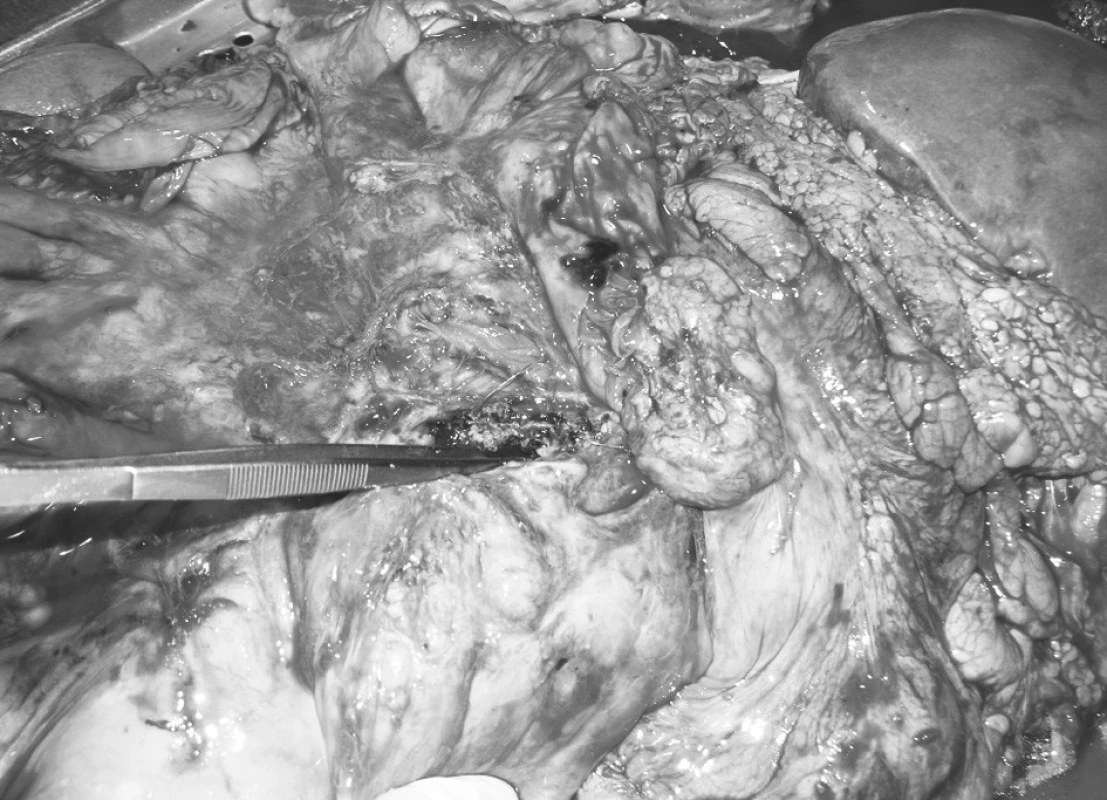 Nález recidivující aorto-enterální píštěle při pitvě
Pic. 1. An autopsy finding of a relapsing aortoenteral fistula