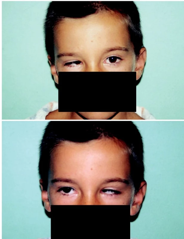 Oboustranný Duanův retrakční syndrom a – pohled doleva, b – pohled doprava