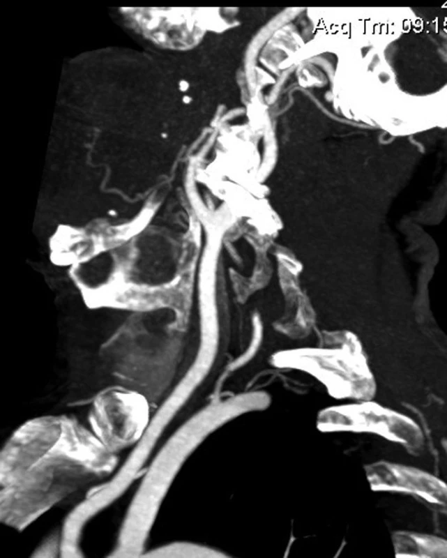 CT-angiografie snímky