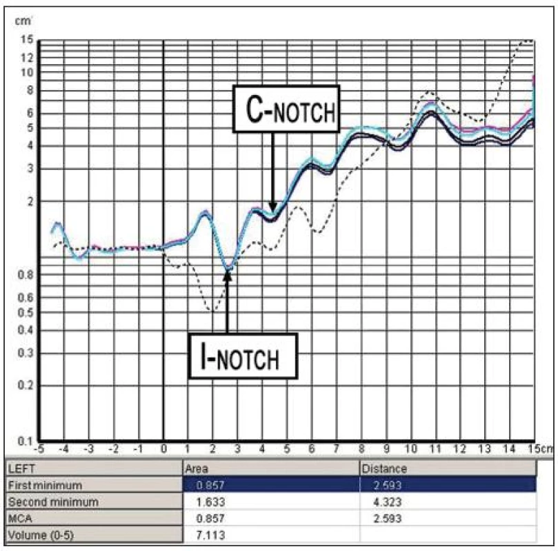 Grafické znázornění vyšetření akustickou rinometrií s vyznačením I- notch (I - Istmus, označuje nosní chlopeň)
a C- notch (C- Concha, oblast hlavy dolní skořepy). V tomto případě I- notch odpovídá MCA (Minimal Crossectional Area).