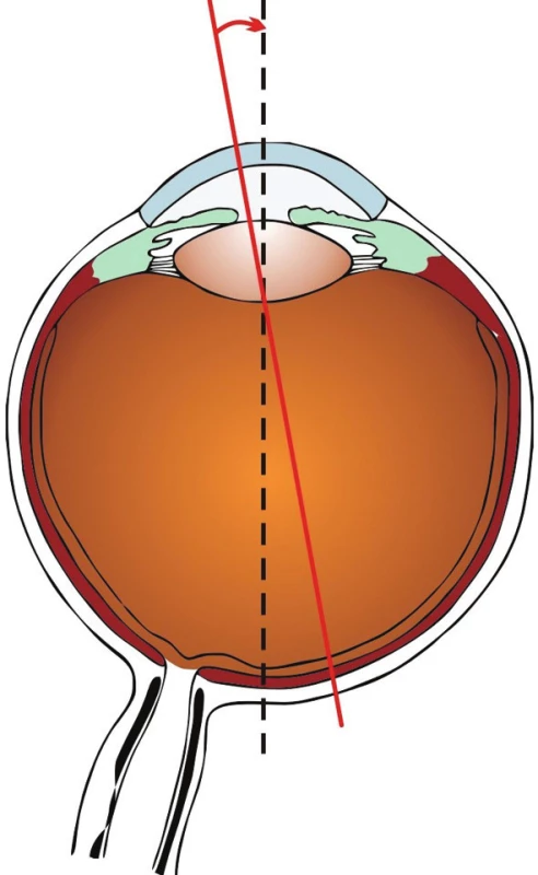 Úhel kappa je úhel, který svírá osa vidění (spojnice mezi fixačním bodem a foveu) a pupilární přímka (přímka jdoucí středem zornice kolmo na rohovku)