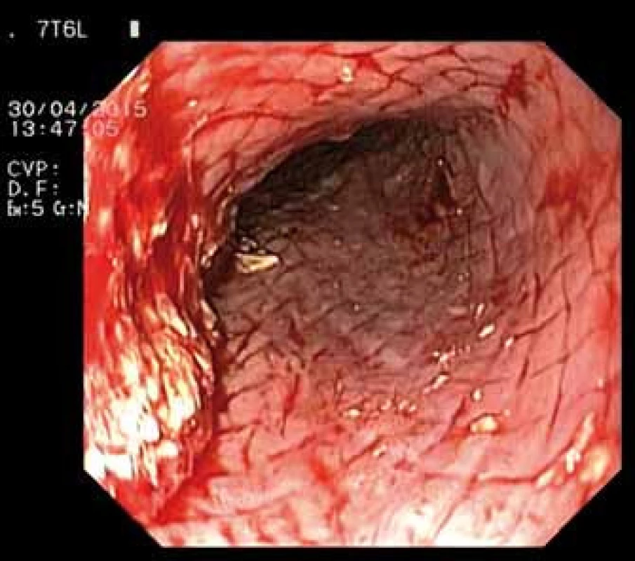 Jícen po extrakci stentu – endoskopický pohled.
Fig. 4. Oesophagus after stent extraction – endoscopic image.