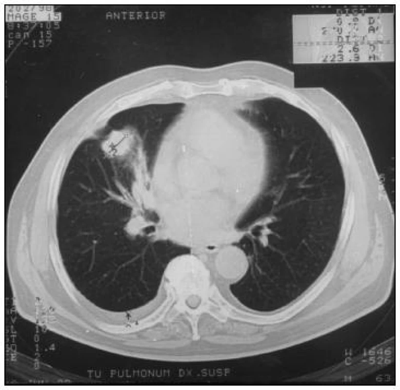 CT pľúc – horizontálny rez oblasťou stredného pľúcneho poľa – diagnóza adenokarcinom pľúc z azbestu s MTS