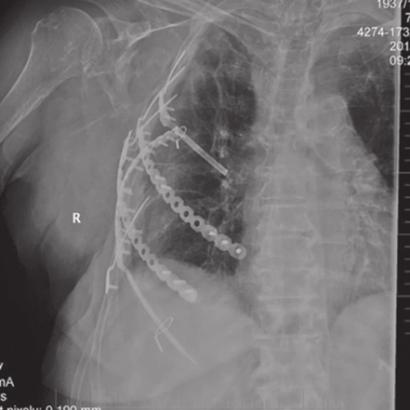 Snímek po stabilizaci
Fig. 2: X-ray after stabilization