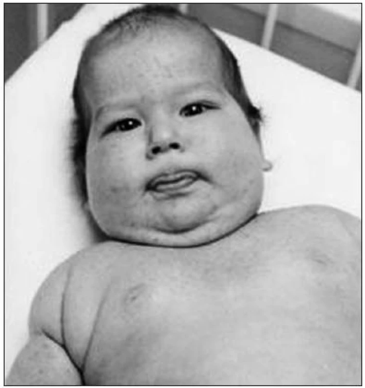 Roční kojenec s Cushingovým syndromem na podkladě adenomu nadledvin s produkcí kortisolu a v malé míře androgenů. Kromě typického cushingoidního habitu je v obličeji nápadné steroidní akné.