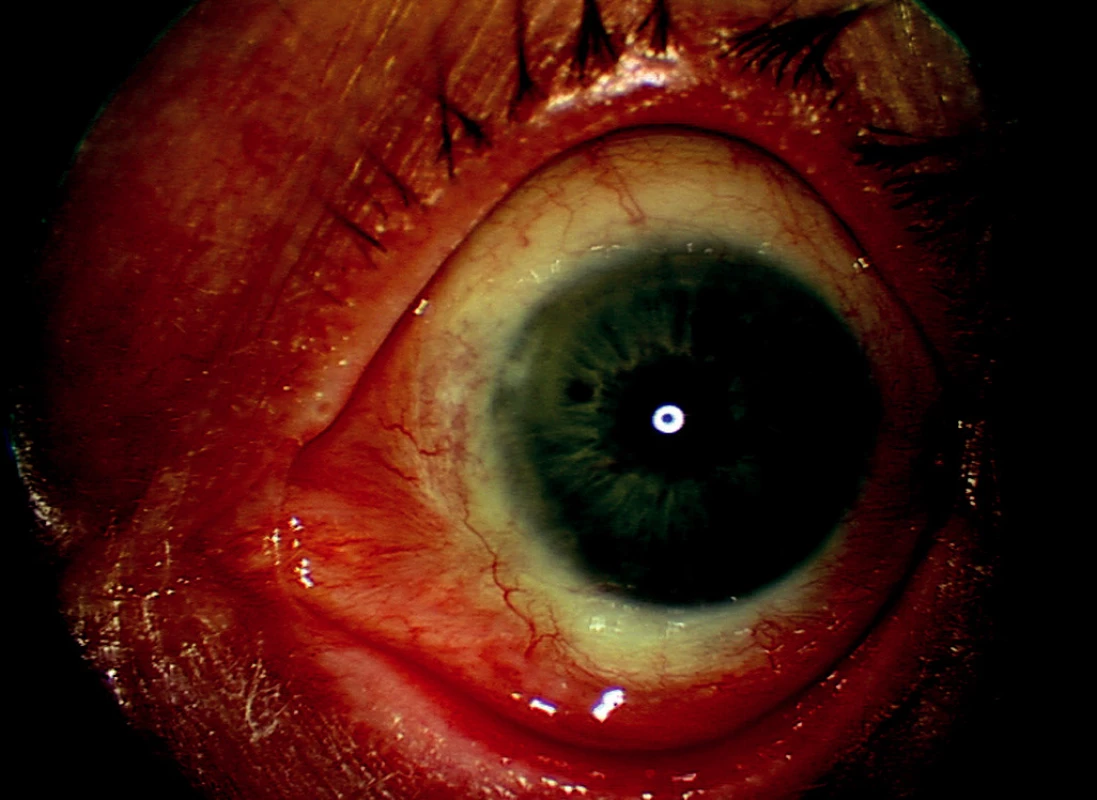 Levé oko – 4 roky po poslední reoperaci