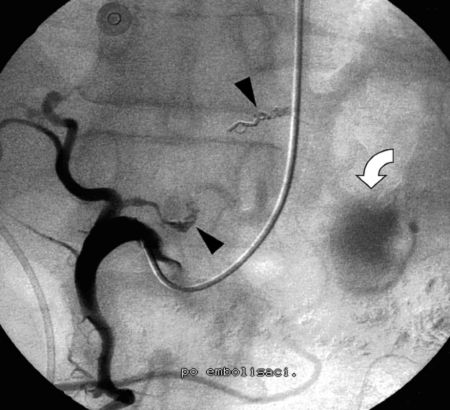 Postembolizační angiogram společné hepatické tepny ukazuje kovové spirály v obou uzavřených gastrických tepnách (šipky); přetrvávající opacifikace v p