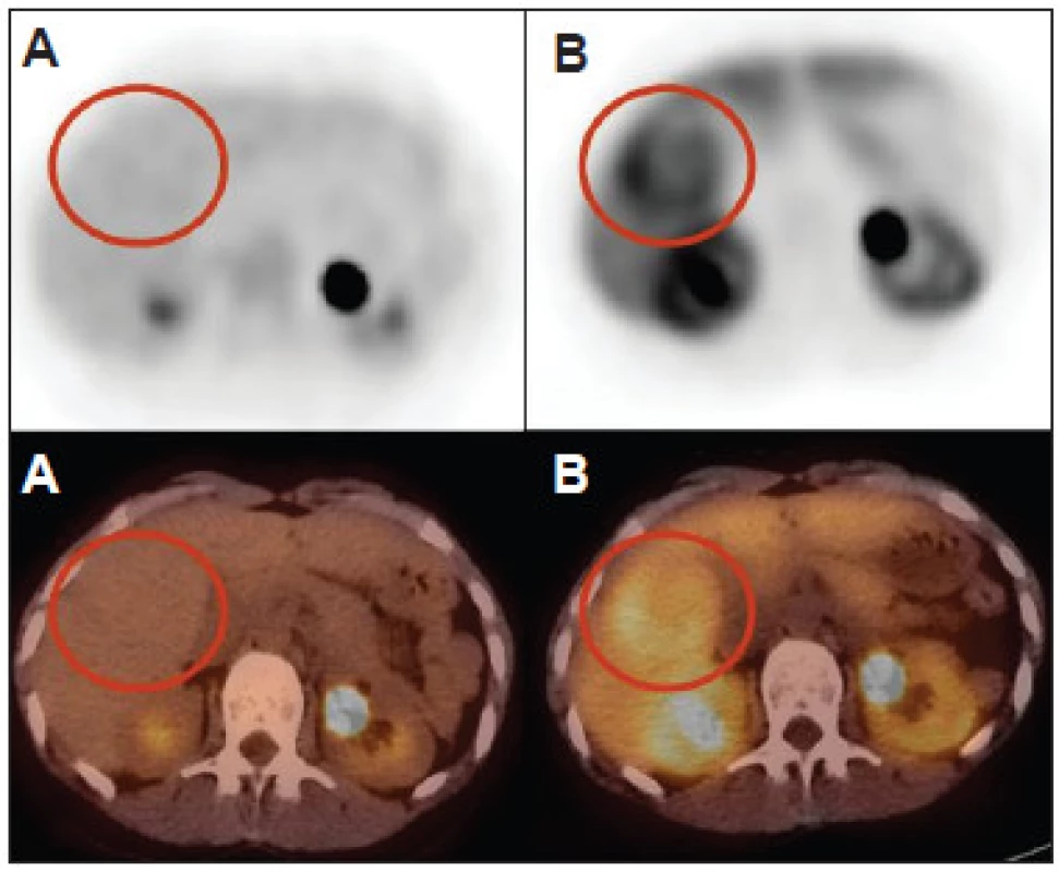 Fokálna nodulárna hyperplázia (FNH) je typicky negatívna s FDG (A) a pozitívna s FCH (B). FNH môže byť zdrojom falošne pozitívneho nálezu pri podozrení na hepatocelulárny karcinóm, môže však byť rozpoznaná na MRI. Typický nález FNH s FDG a s FCH môže byť nápomocný pri odlíšení FNH od hepatocelulárneho adenómu.