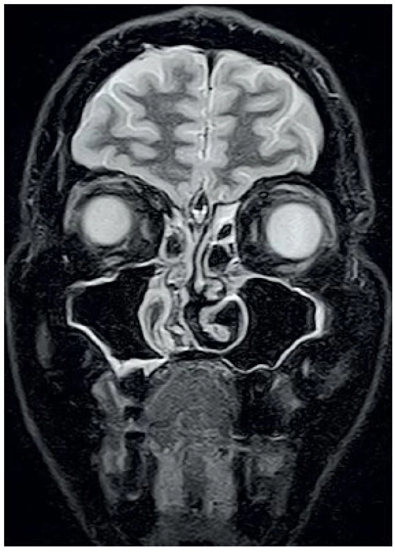 MRI očnic STIR, koronární řez – výrazná regrese infiltrátu vlevo