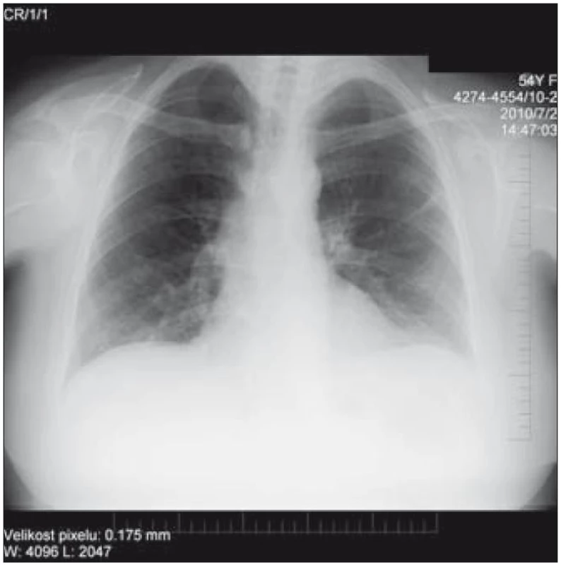 Prostý PA RTG snímek hrudníku nativ. Transparence plicního parenchymu vpravo apikálně a oboustranně v okolí hilů je zřetelně snížená, oboustranně zesílená interlobia, oboustranně při bazích plic naopak se transparence plicního parenchymu difuzně zvyšuje více, než bývá obvyklé. Kontury bránice jsou hladké, siny kostofrenické jsou volné. Srdce příčně uložené, nerozšířené (Popsal doc. MUDr. Petr Krupa, CSc., přednosta Kliniky zobrazovacích metod FN u sv. Anny v Brně.).
