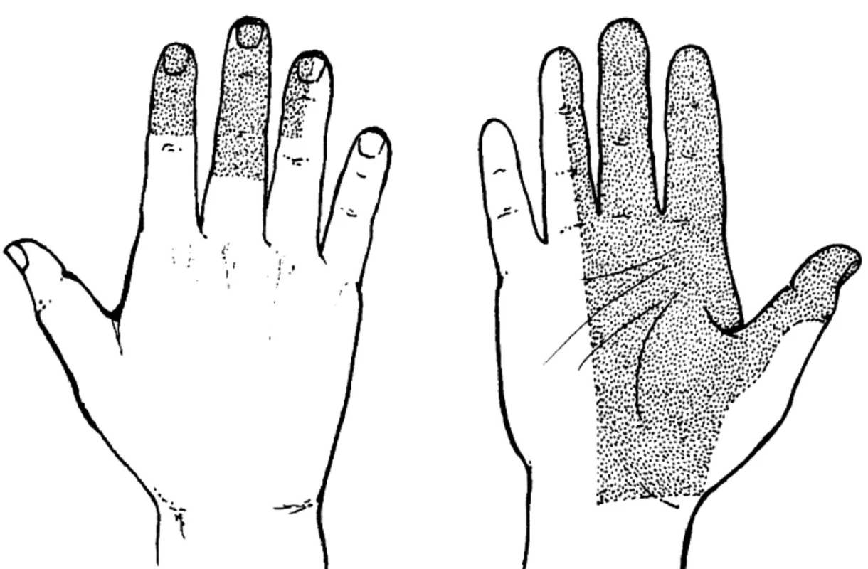 Syndrom karpálního tunelu – porucha čití.
Porucha čití na dlani a I.–III.prstu, radiální polovině IV. prstu a také dorzální plochy distálních dvou článků
II. až IV.prstu. Radiální část thenaru je inervována r. palmaris n. mediani.