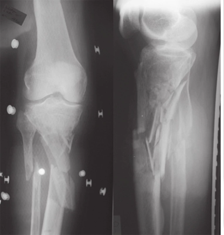 RTG natívne snímky – trieštivej defektnej metafyzárnej zlomeniny proximálnej časti pravej tíbie
Fig. 2: X-ray native scans – comminuted right tibial fracture with osseous metaphyseal bone defect
