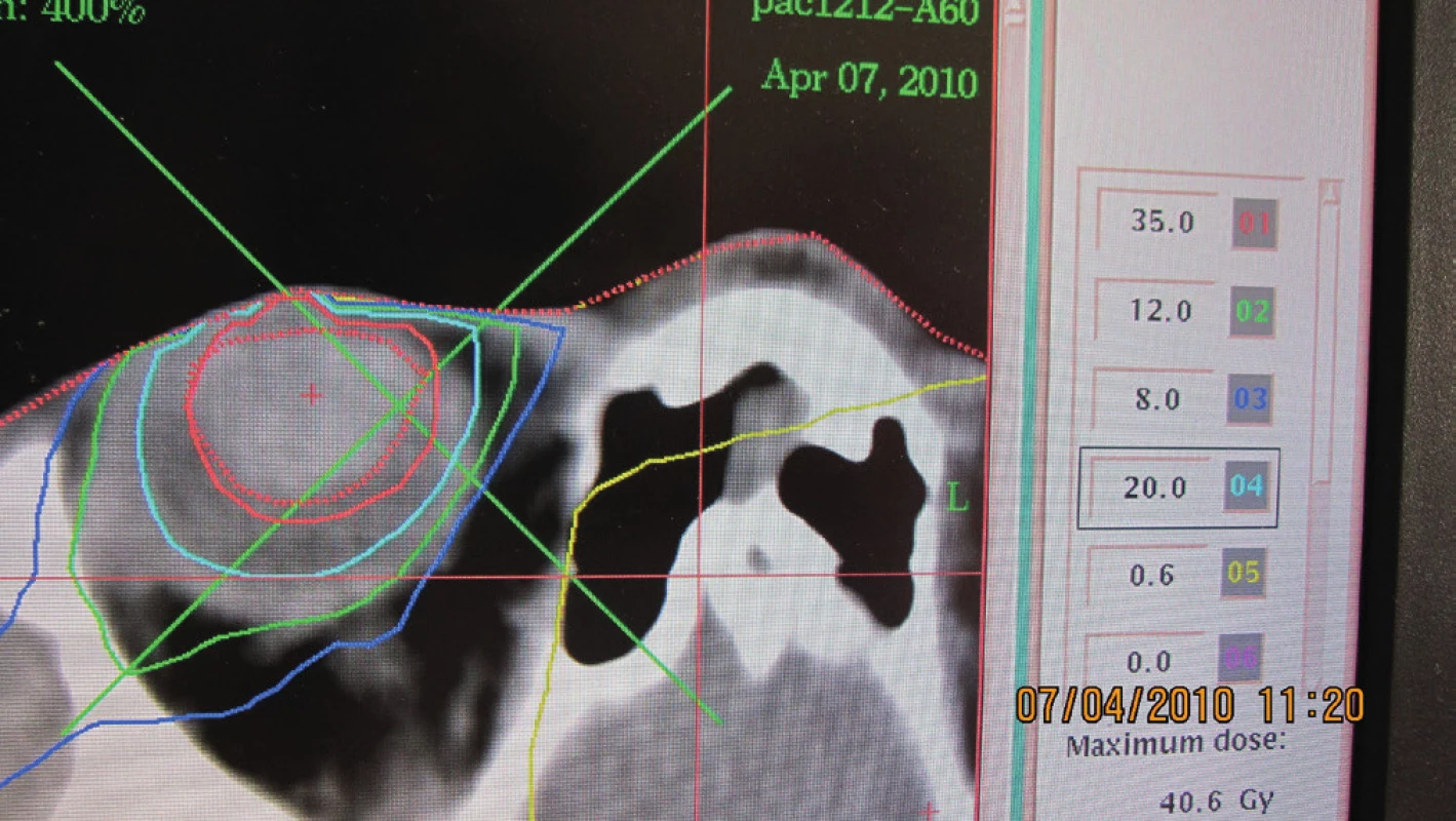 Stereotaktický rádiochirurgický plán pacientky s veľkým vnútroočným melanómom – objem 1,0 cm&lt;sup&gt;3&lt;/sup&gt; (apríl 2010)