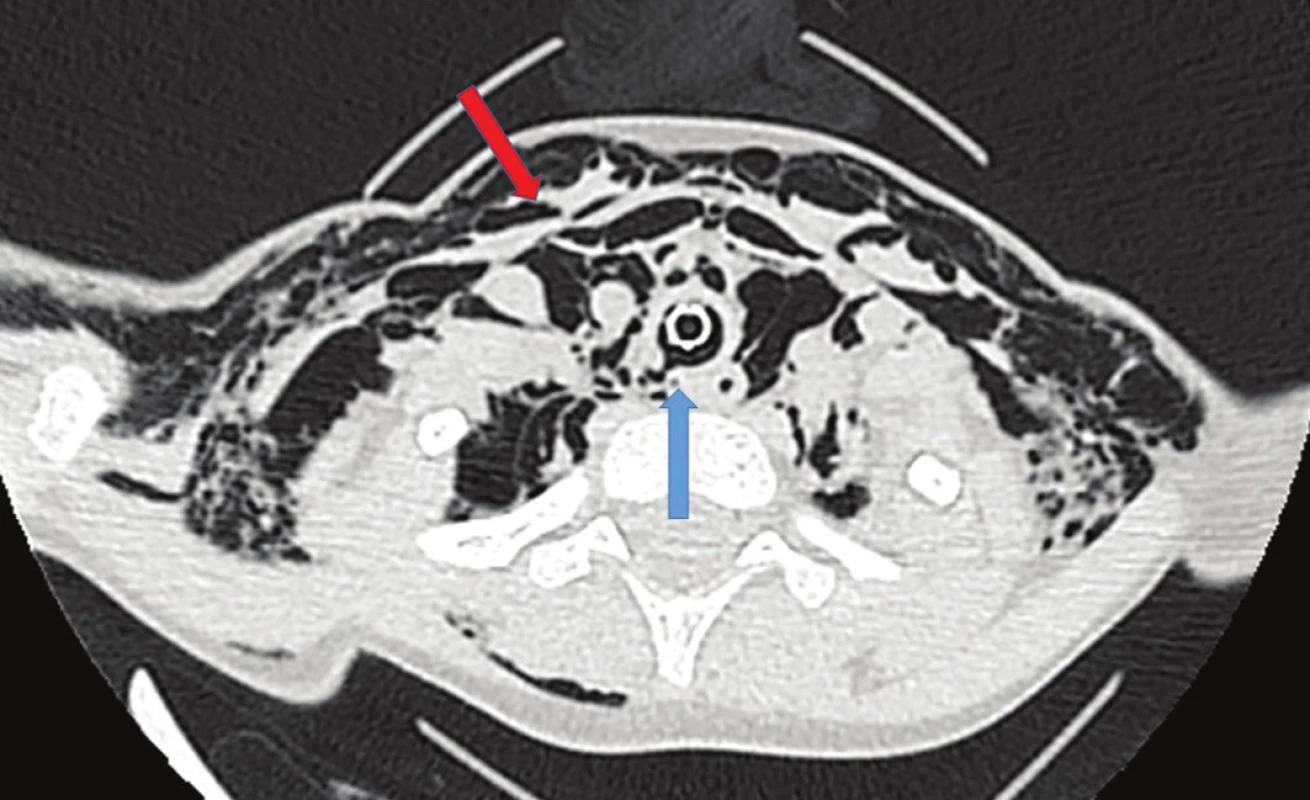 CT nález u 7letého chlapce po pádu na pařez. Poranění zadní stěny průdušnice (modrá šipka) komunikující s pneumomediastinem a podkožním emfyzémem (červená šipka), endotracheální rourka přemosťující místo poranění. Zhojeno při konzervativním postupu.
Fig. 3: CT findings in a 7 years old boy after falling on a tree stump. Injury of the posterior tracheal wall (blue arrow); subcutaneous emphysema (red arrow). Endotracheal tube crossing the site of injury. Healed up on conservative treatment.