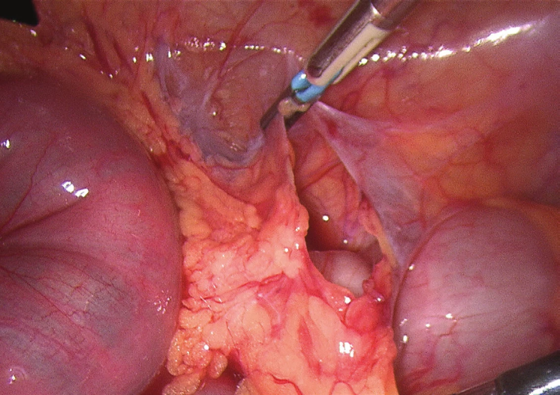 Laparoskopický obraz kýlní branky vnitřní kýly
Fig. 5: Laparoscopic image of the internal hernia orifice