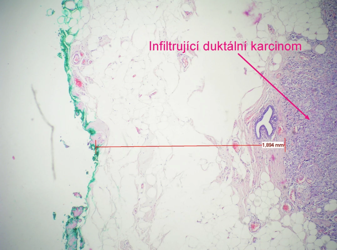 Histologický obraz duktálního karcinomu se zbarveným resekčním okrajem a vyznačenou vzdáleností tumoru od okraje preparátu
