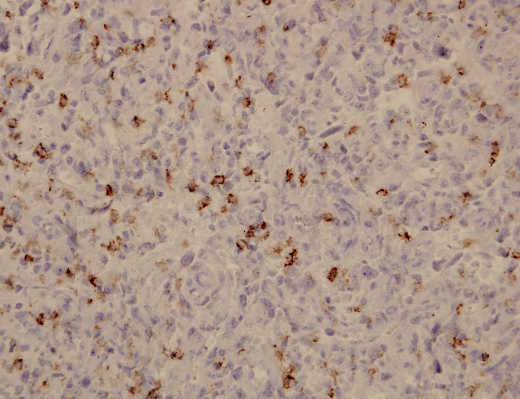Nádor z juxtaglomerulárních buněk ledviny – fokální cytoplazmatická pozitivita CD117, 400krát