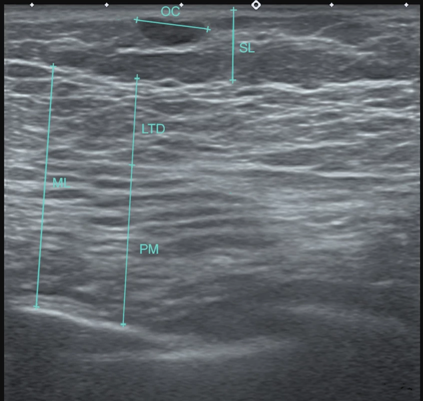 Typical postoperative ultrasound image. Muscular layer (ML) after fat grafting is shown as a homogeneous structure with significant lipomatous changes without oil cysts or fat necroses. The pectoralis (PM) and the latissimus dorsi (LTD) muscles can be distinguished according to the orientation of muscle fibers. There are single medium size oil cysts (OC) in the subcutaneous layer (SL)