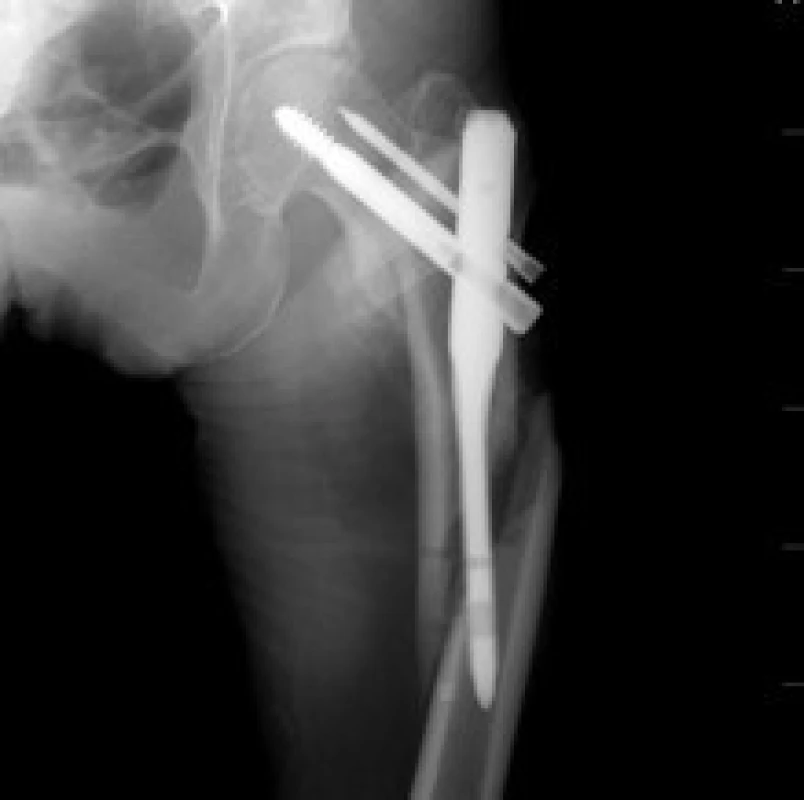 4 týdny po OS pacientka upadla na operovanou končetinu a způsobila si frakturu femuru