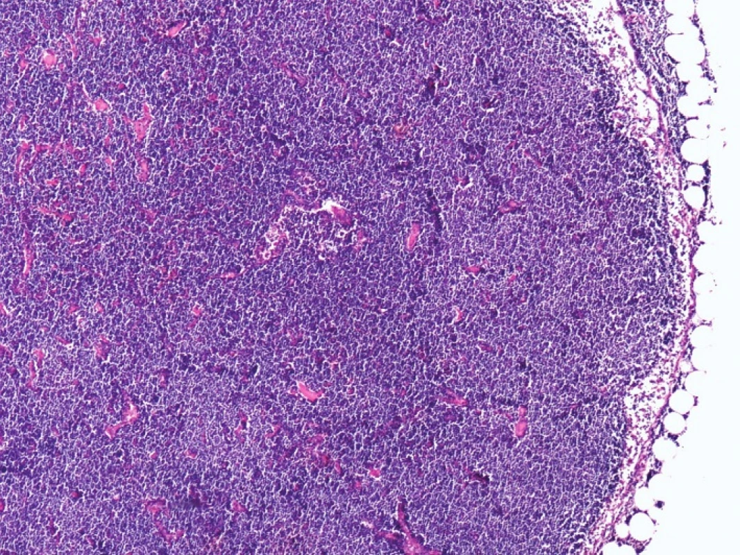 Kazuistika 2 – mízní uzlina s infiltrací malobuněčným B-lymfomem CLL/SLL, s lymfomovou infiltrací okolní tukové tkáně (HE, 10x)
Fig. 3: Case 2 – lymph node infiltrated by small cell B-cell lymphoma CLL/SLL, with lymphoma infiltration of the surrounding fat tissue (HE, 10x)