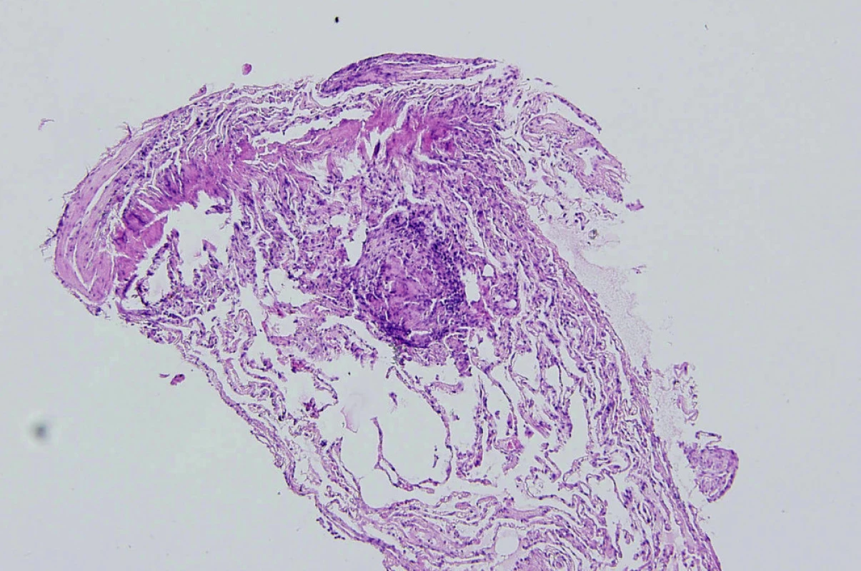 Histologický obraz granulomu u sarkoidózy