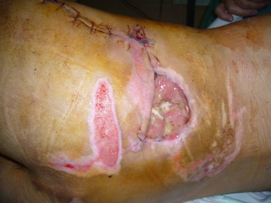 Stav levé hýždě po parciální sutuře kožního krytu před následnou dermoepidermální plastikou zbytkového defektu kůže