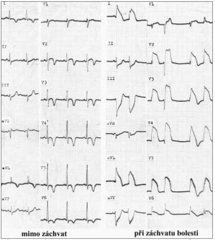 EKG obraz vazospaztické anginy.