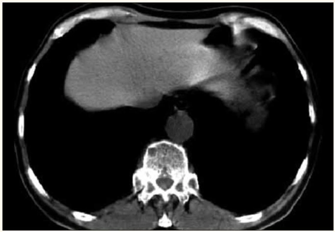 Menší osteolytické ložisko hrudního obratle a hlavičky žebra vlevo v CT obraze.