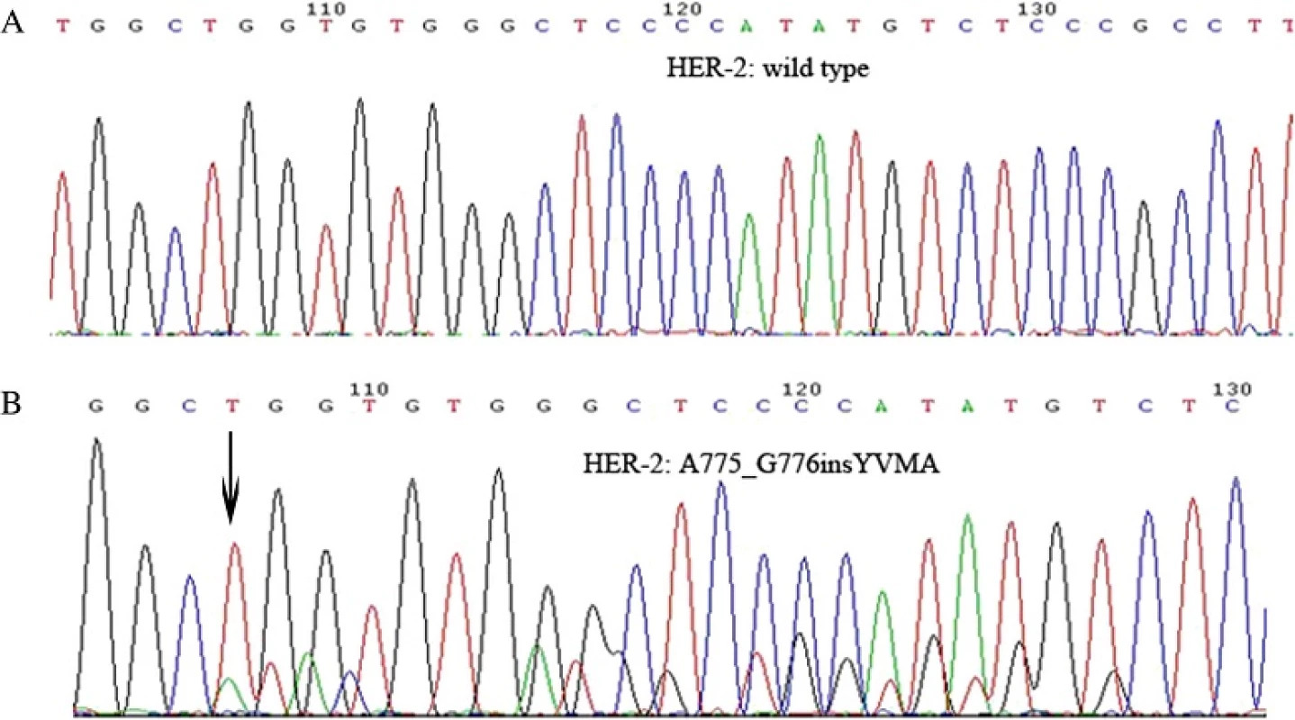 The confirmed results of HER-2 mutations by DNA sequencing. a HER-2 wild type; b The arrow showed HER-2 A755_G776insYVMA