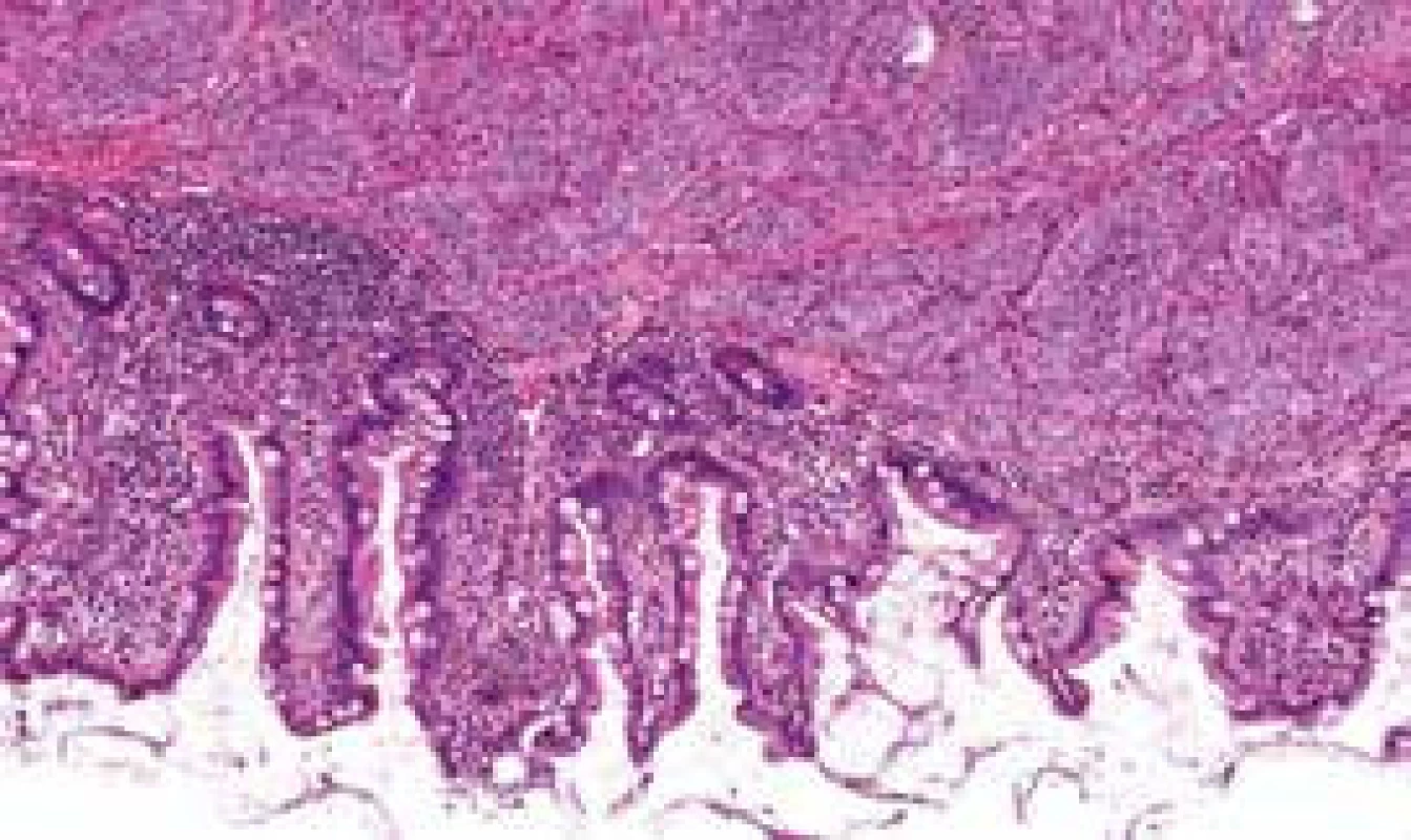 Histological section: NET infiltrating
submucosa of the small bowel wall,
HE staining, 200×
