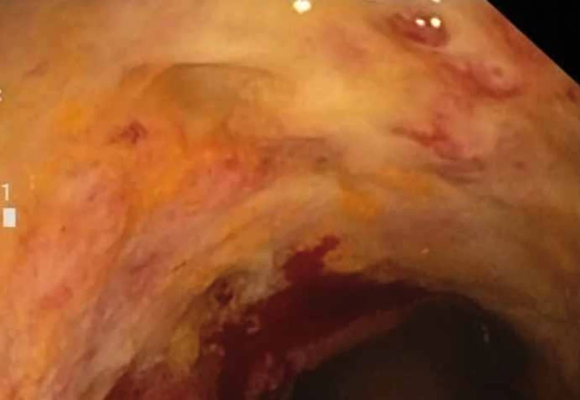 Stenóza střeva s regresí stenózy po dvou týdnech, s ulcerovanou spodinou.
Fig. 4. Stenosis of the bowel with stenosis regression after two weeks, with ulceration.