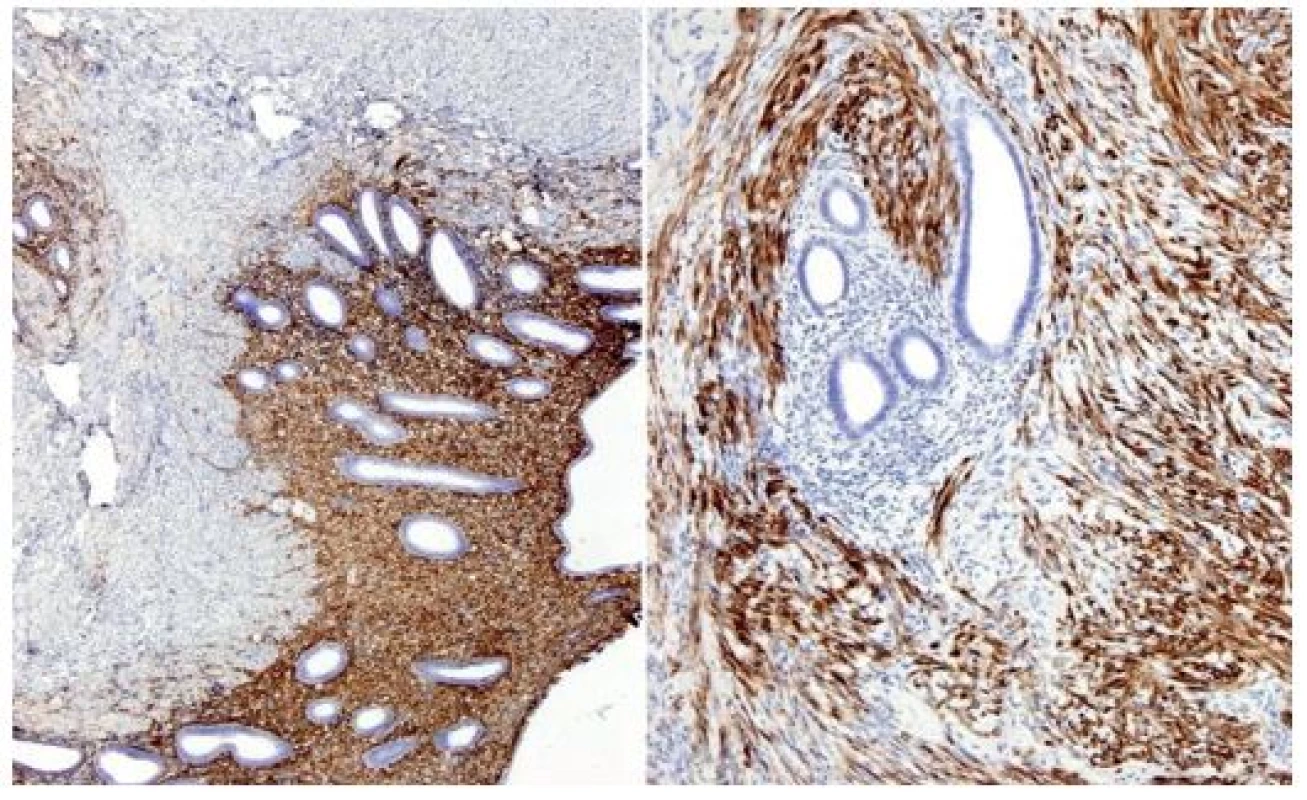 Histopatologický obraz endometriózy (imunohistochemie)
Fig. 4: Histopathological finding of endometriosis (immunohistochemistry)