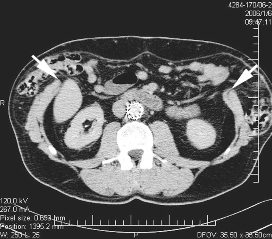 Nativní CT břicha v úrovni L3, zobrazující defekt břišní stěny. Šipky označují okraje svalové břišní stěny.
Pic. 5. Native abdominal CT scan at the level of L3 showing the defect of abdominal wall. Arrows mark borders of muscular abdominal wall.