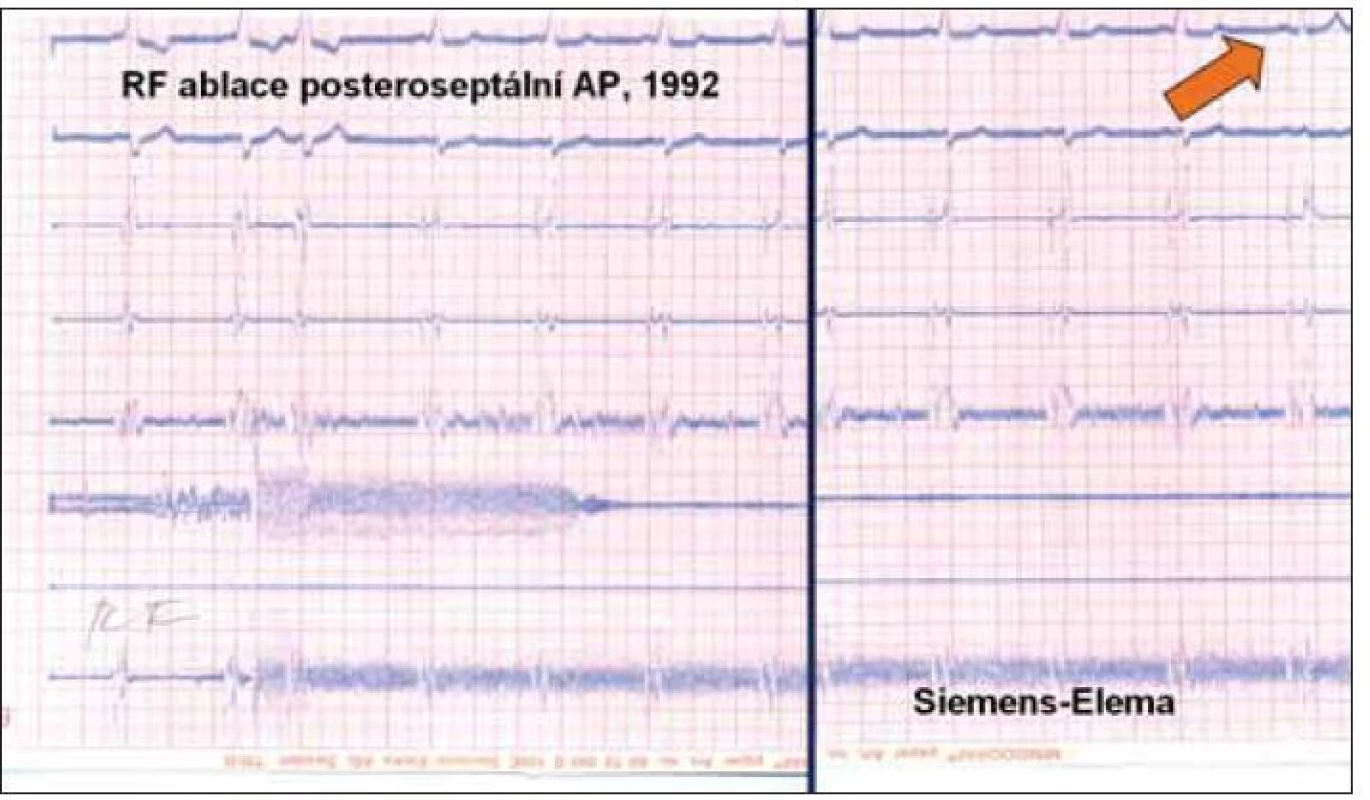 Záznam z první radiofrekvenční ablace pro arytmii v ČR z roku 1992. EKG i intrakardiální signály z katétrů byly zaznamenávány kontinuálně na papír tryskovým zapisovačem (Mingograph, Siemens-Elema). Šipka označuje vymizení vlny delta během aplikace radiofrekvenční energie.