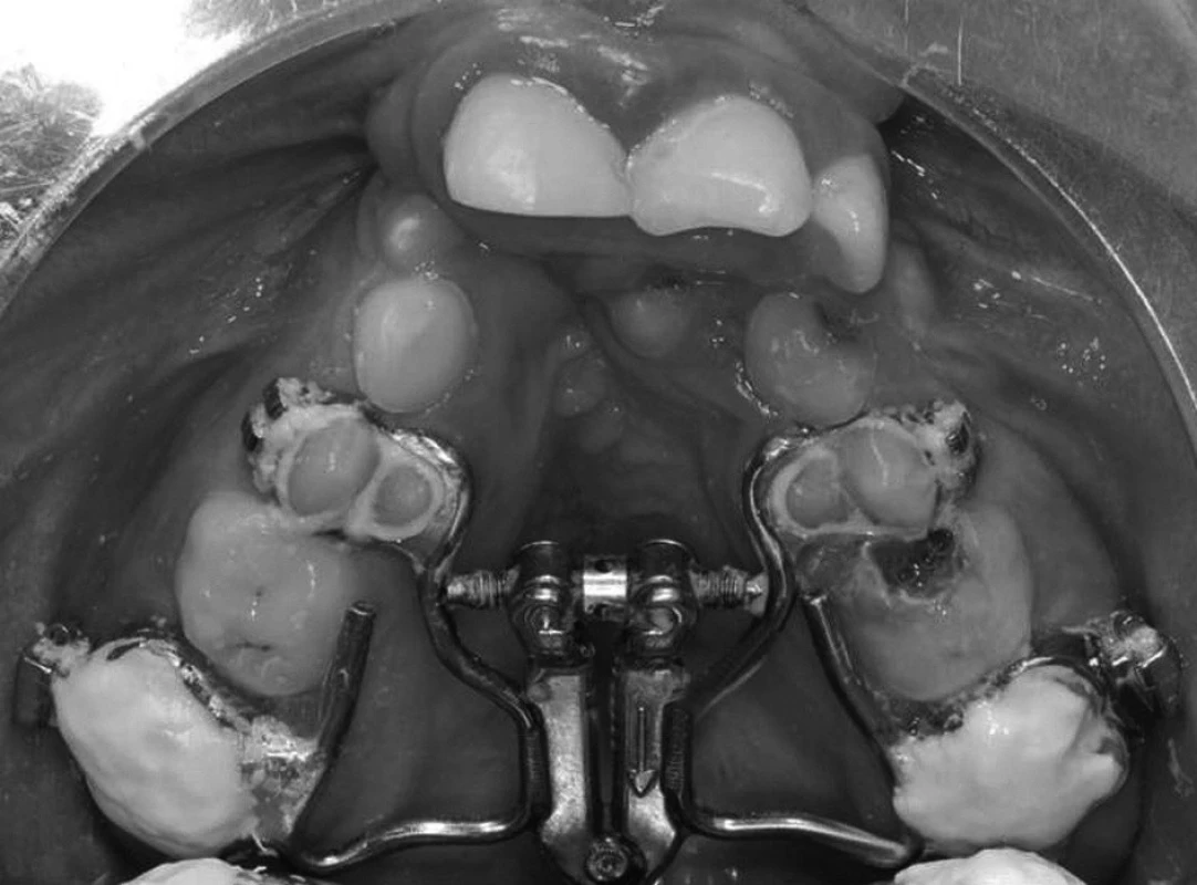 Horní zubní oblouk pacienta po nasazení expanzního aparátu s vějířovým hyrax šroubem, na prvních horních molárech jsou nákusy přechodně zvyšující skus.