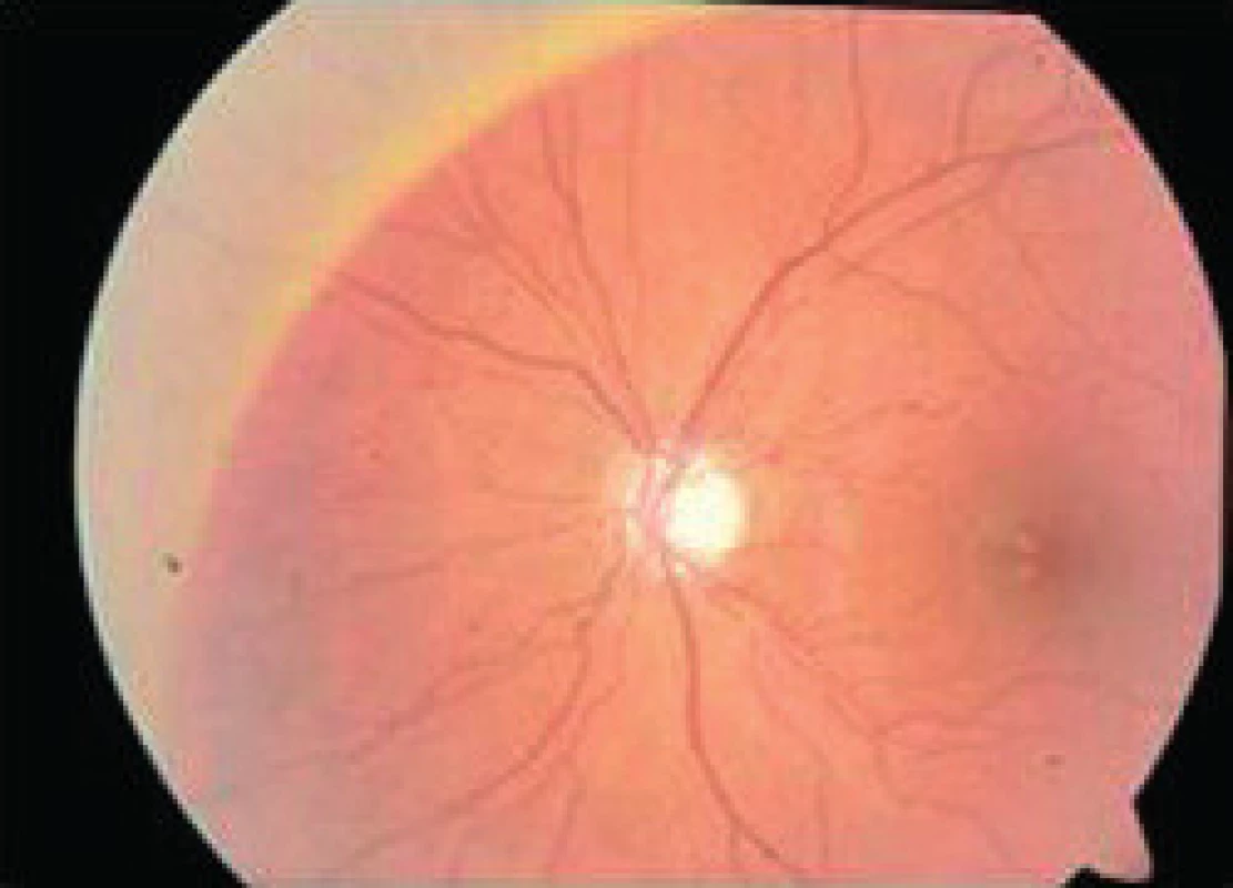 Atrofia terča zrakového nervu pri metachromatickej leukodystrofii