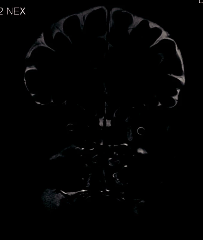 MRI – zbytnění a prosáknutí okohybných svalů vlevo