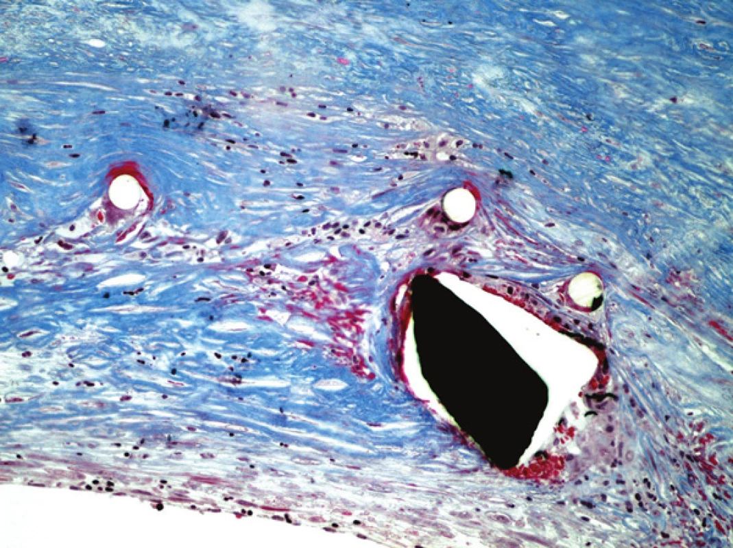 Detail stěny štěpu, známky fibrotizace stěny cévní. Barveno modrým trichromem (zvětšeno 200x).