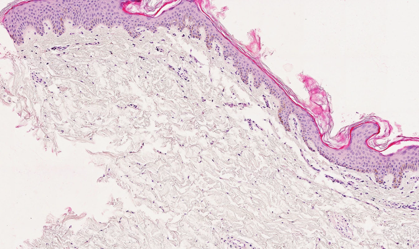 Teleangiectasia macularis eruptiva perstans. V barvení HE nenápadné nediagnostické infiltráty (obj. 10x).