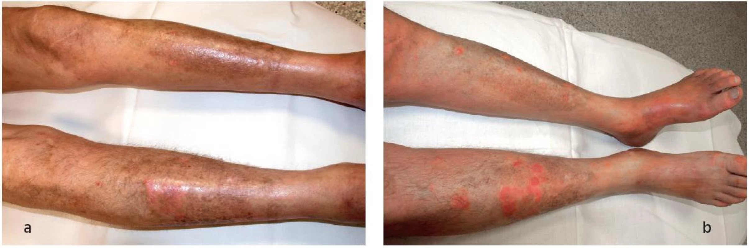 Kožní nález na dolních končetinách při stanovení diagnózy (a) a po terapii (b). Kožní nález je částečně modifikován současným výsevem psoriázy, kterou pacient trpí dlouhodobě.