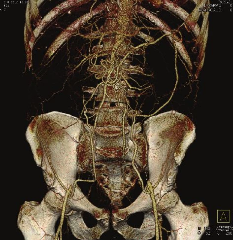 Uzávěr subrenální aorty – CTAG
Fig. 1: Occlusion of the subrenal aorta – CTAG