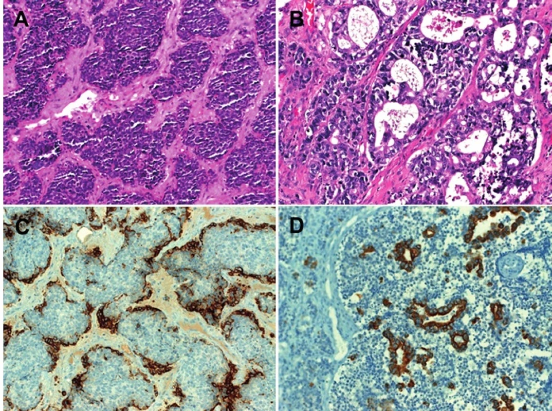 Several neoplasms classified as high-grade non-intestinal adenocarcinoma frequently show foci similar to esthesioneuroblastoma (A) associated with glandular component (B). Synaptophysin highlighted peripherally located cell aggregates that were positive for calretinin as well suggesting limited olfactory-like differentiation (C). Strong expression of pancytokeratin limited to glands indicates true epithelial differentiation (D).