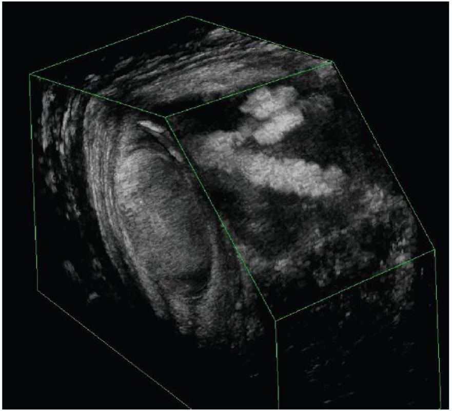 3D endosonografický obraz dvouchobotové píštěle tvaru „V“
Fig. 3: 3D endosonography imaging of double-sinus V-shaped fistula