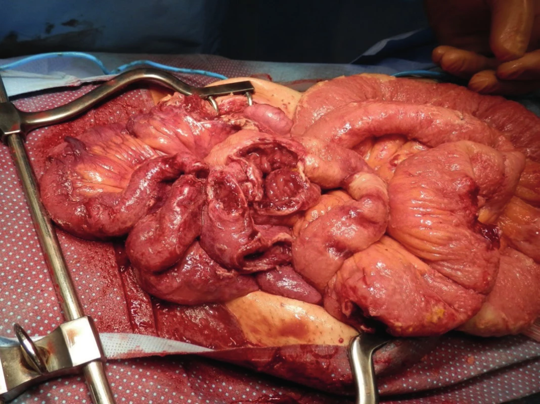 Operation findings 3 days later – multiple extensive perforations with intestine disintegration