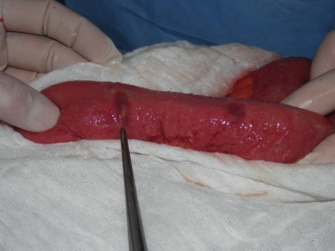 Operation findings during the first operation – “bowllike” ulcers in the jejunum with pin-point perforations