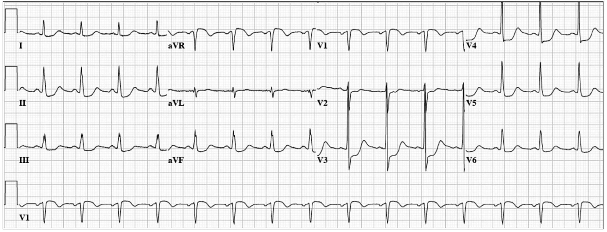 62 year-old man with acute chest pain and hypotension.