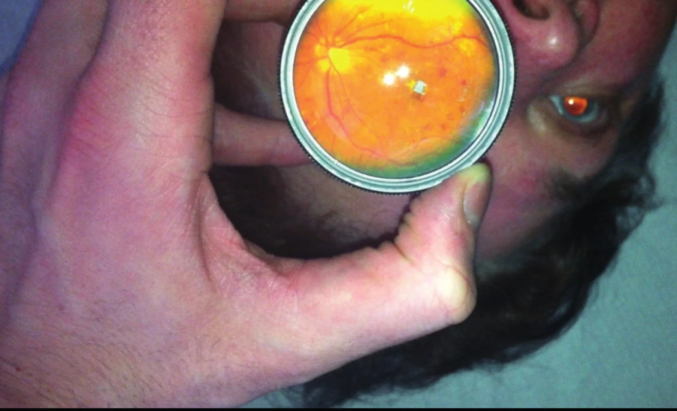 Snímek centrální krajiny sítnice u 62letého pacienta s diabetickou retinopatií s makulopatií.