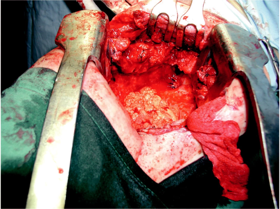 Peroperačný pohľad na miesto sutúry kýpťa bronchu
Fig. 2. A peroperative view of the bronchial fistula suture