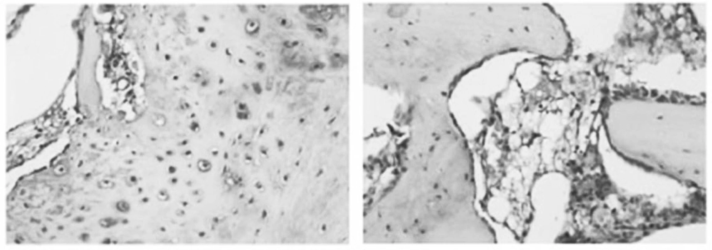 Koncentrace von Willebrandova faktoru /vWF/ v imunohistochemickém nálezu. vWF autor považuje jako marker angiogeneze. Jeho koncentrace je signifikantně zvýšena u ESWT skupiny /tmavé partikule na obrázku vlevo/ v porovnání s kontrolním souborem. (Převzato z Wang C. J. et al., Rheumatology, 2008.)